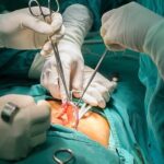 Appendix Removal Surgery