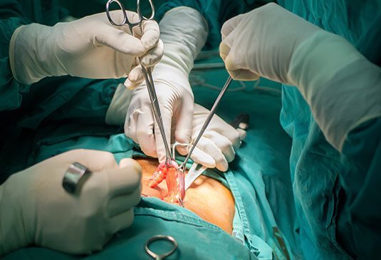 Appendix Removal Surgery