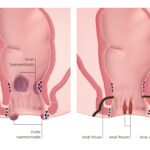 Hemorrhoids