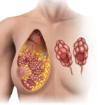 Benign Breast Disease: