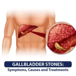 gallbladder stones