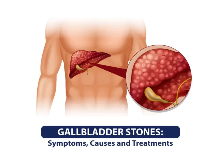 gallbladder stones