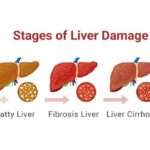 Fatty Liver Disease