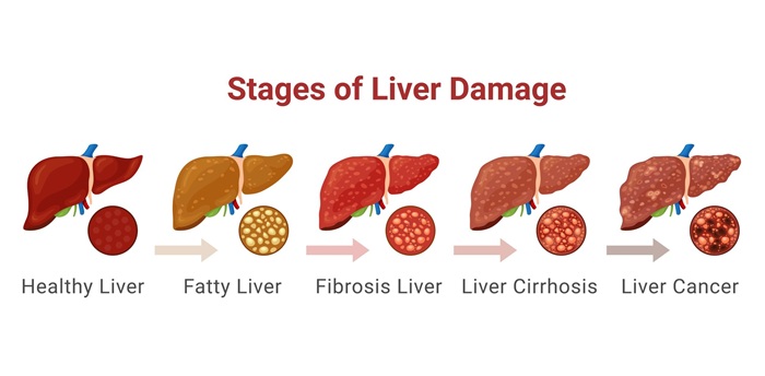 Fatty Liver Disease
