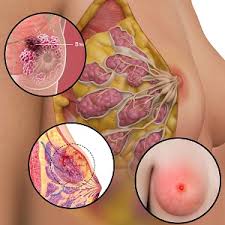 Gallbladder Surgery Nashik